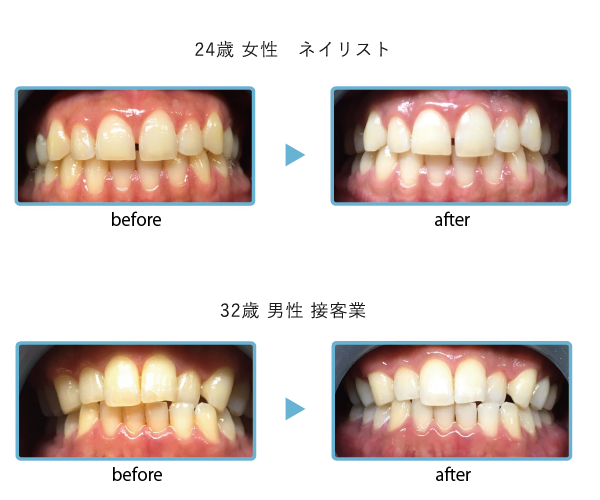 セルフホワイトニングの効果